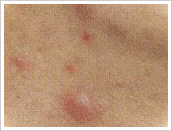 化膿したニキビ