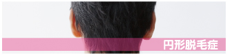 円形脱毛症